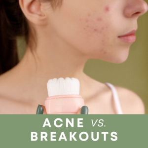 the difference between acne and breakouts